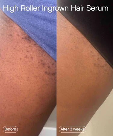 Topicals  High Roller Ingrown Hair Tonic with AHA and BHA