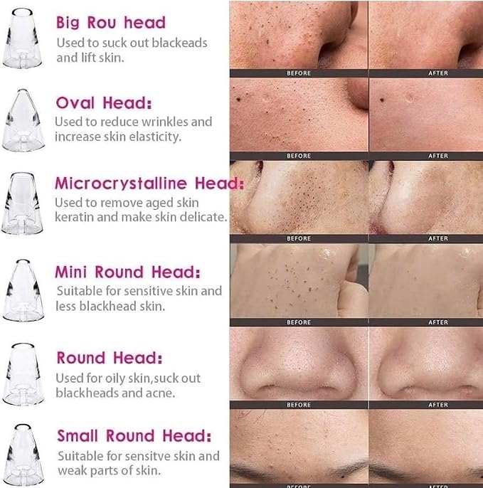 Blackhead Remover Multifunctional 6 in 1 Tool | Electric Derma suction Machine | Pimple Acne Pore Cleaner Vacuum Tool | USB Rechargeable | Facial Cleanser Device for Nose & Skin Care | For MEN & WOMEN