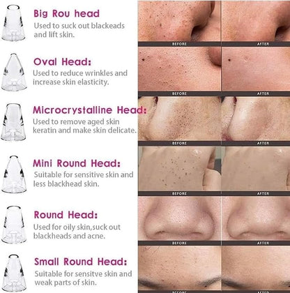 Blackhead Remover Multifunctional 6 in 1 Tool | Electric Derma suction Machine | Pimple Acne Pore Cleaner Vacuum Tool | USB Rechargeable | Facial Cleanser Device for Nose & Skin Care | For MEN & WOMEN